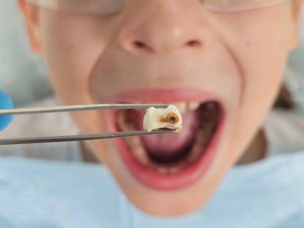 Best Pediatric Emergency Dentist in Yelm, WA